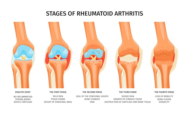 膝关节类风湿性关节炎